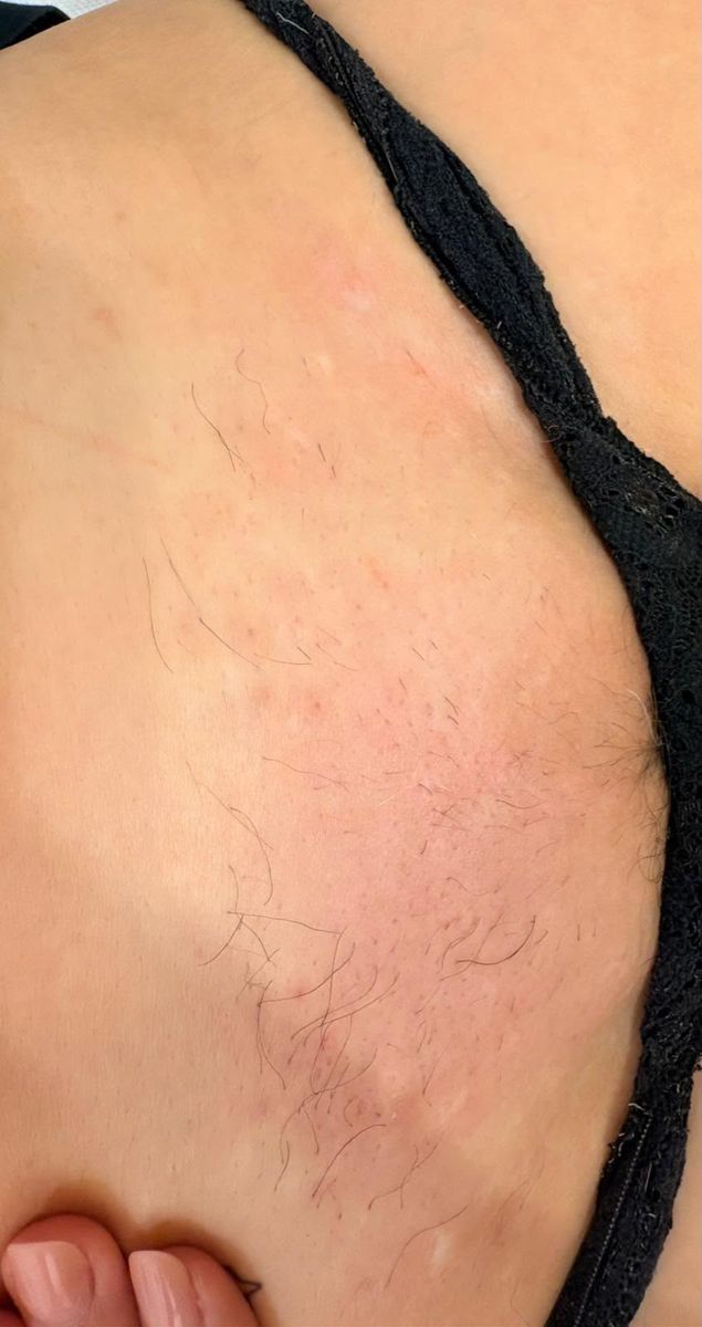 Epilazione laser, inguine, dopo 2 sedute