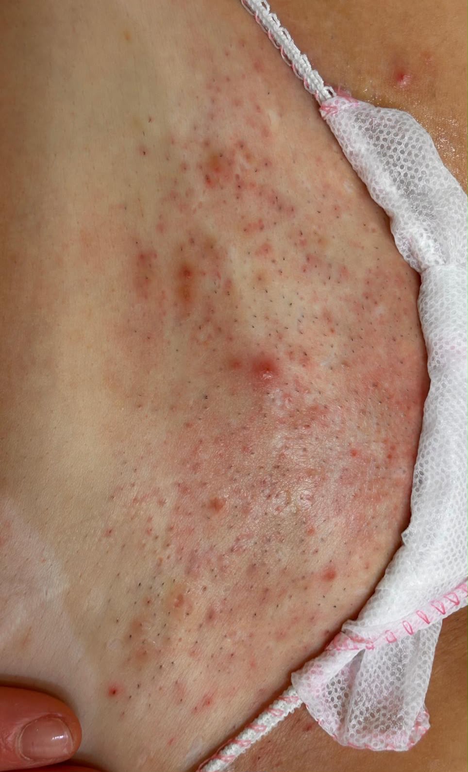 Risultato epilazione laser — inguine, prima del trattamento