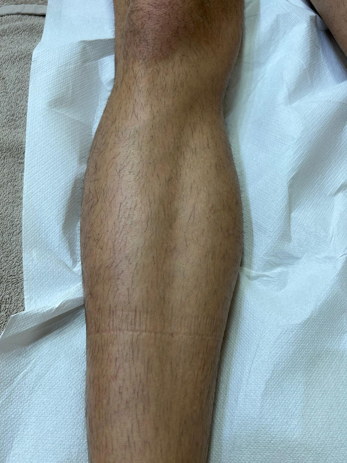 Risultato epilazione laser — gamba, prima del trattamento