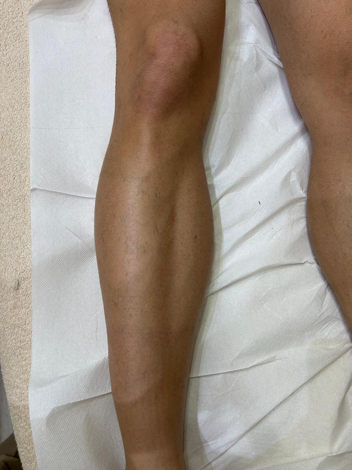Risultato epilazione laser — gamba, dopo 2 sedute